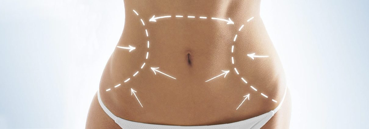 Abdominoplastia